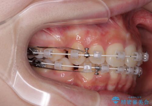 出っ歯を治したい ワイヤー装置での抜歯矯正の治療中