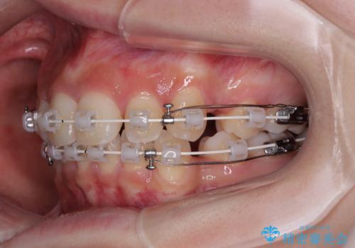 出っ歯を治したい ワイヤー装置での抜歯矯正の治療中