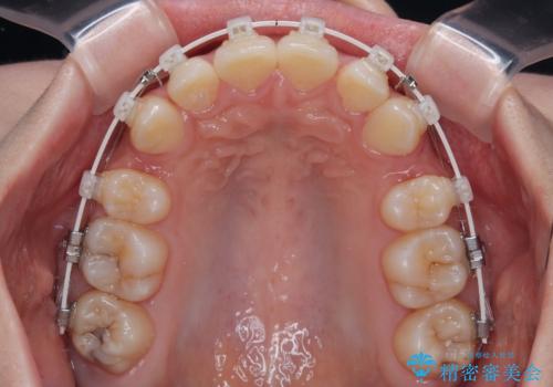 出っ歯を治したい ワイヤー装置での抜歯矯正の治療中