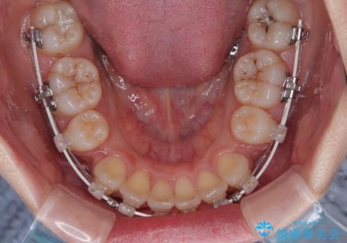 出っ歯を治したい ワイヤー装置での抜歯矯正の治療中