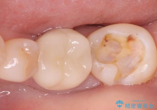 銀歯が取れた 〈セラミックインレー〉の治療中
