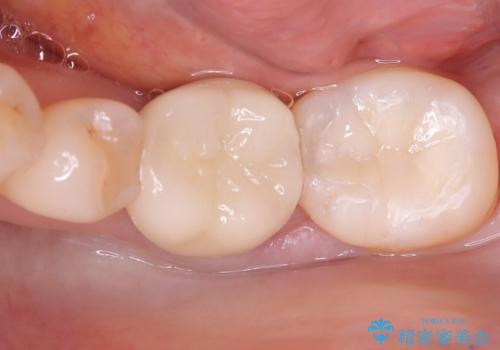 銀歯が取れた 〈セラミックインレー〉の症例 治療後