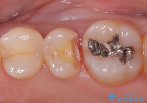 虫歯の治療 〈セラミックインレー〉の治療中