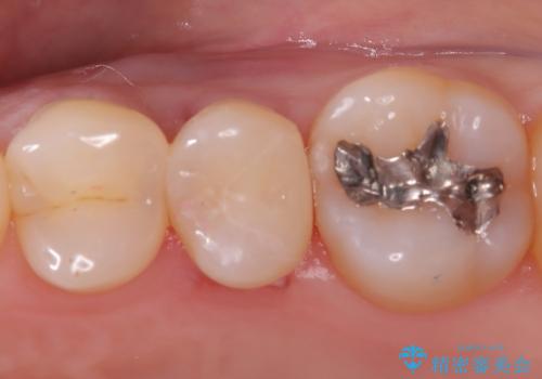 虫歯の治療 〈セラミックインレー〉