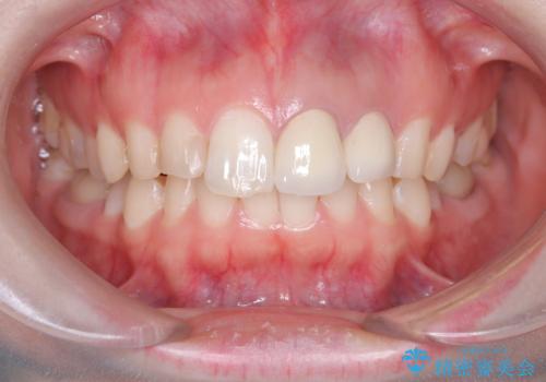 前歯が痛い!|歯の色が気になる!|精密根管治療後、オールセラミッククラウンで審美修復の治療後