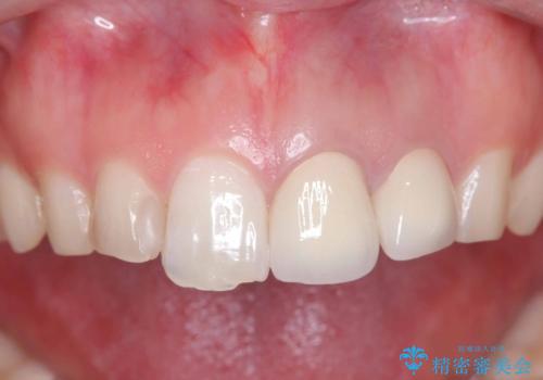 前歯が痛い!|歯の色が気になる!|精密根管治療後、オールセラミッククラウンで審美修復の治療後