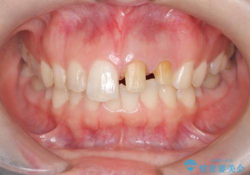 前歯が痛い!|歯の色が気になる!|精密根管治療後、オールセラミッククラウンで審美修復の治療中