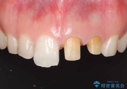 前歯が痛い!|歯の色が気になる!|精密根管治療後、オールセラミッククラウンで審美修復