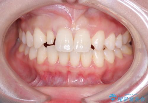 前歯の見た目が気になる!|矮小歯をオールセラミッククラウンで綺麗な形に!|審美回復の治療中