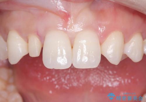 前歯の見た目が気になる!|矮小歯をオールセラミッククラウンで綺麗な形に!|審美回復の治療中