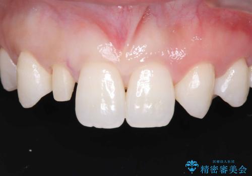 前歯の見た目が気になる!|矮小歯をオールセラミッククラウンで綺麗な形に!|審美回復の治療中
