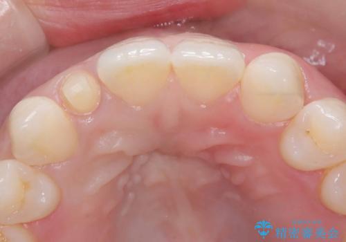 前歯の見た目が気になる!|矮小歯をオールセラミッククラウンで綺麗な形に!|審美回復の治療中