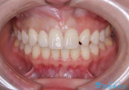 前歯の見た目が気になる!|矮小歯をオールセラミッククラウンで綺麗な形に!|審美回復の治療後