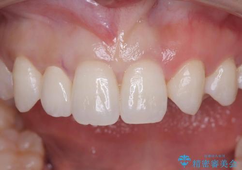 前歯の見た目が気になる!|矮小歯をオールセラミッククラウンで綺麗な形に!|審美回復の治療後