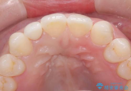 前歯の見た目が気になる!|矮小歯をオールセラミッククラウンで綺麗な形に!|審美回復の治療後