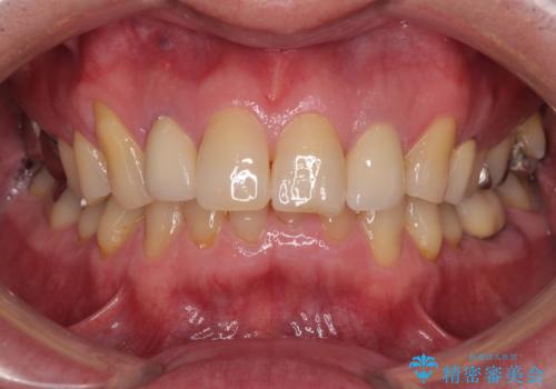 前歯の色味を治したい オールセラミッククラウンの治療後