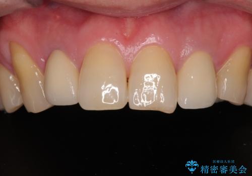 前歯の色味を治したい オールセラミッククラウンの症例 治療後
