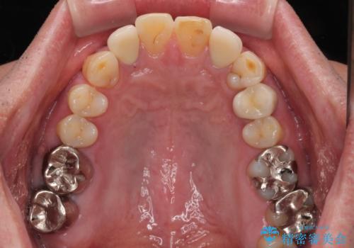 前歯の色味を治したい オールセラミッククラウンの治療後