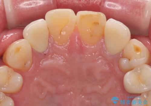 前歯の色味を治したい オールセラミッククラウンの治療後