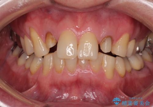 前歯の色味を治したい オールセラミッククラウンの治療中