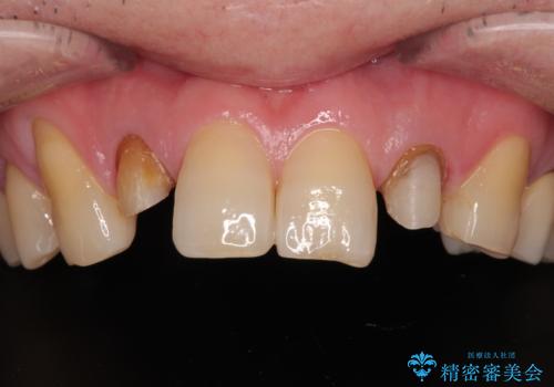 前歯の色味を治したい オールセラミッククラウンの治療中