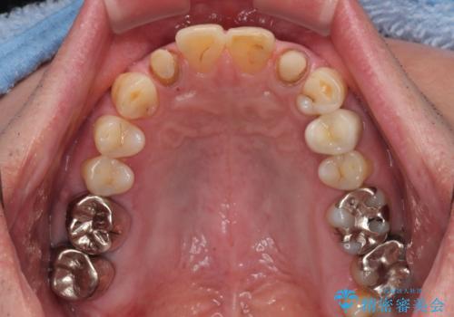 前歯の色味を治したい オールセラミッククラウンの治療中