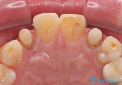 前歯の色味を治したい オールセラミッククラウンの治療中