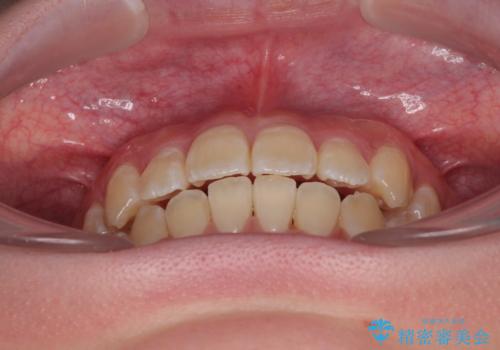 【モニター】前歯のデコボコをスッキリ解消!目立ちにくいワイヤー矯正でスピーディに治療完了の治療後