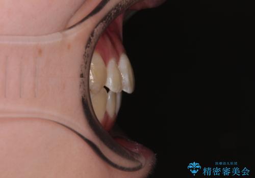 【モニター】前歯のデコボコをスッキリ解消!目立ちにくいワイヤー矯正でスピーディに治療完了の治療後