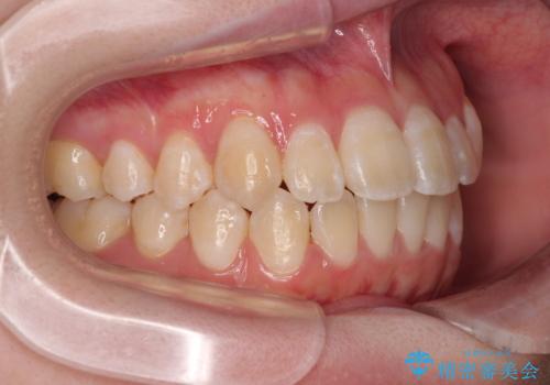 【モニター】前歯のデコボコをスッキリ解消!目立ちにくいワイヤー矯正でスピーディに治療完了の治療後