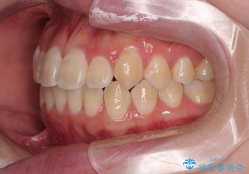 【モニター】前歯のデコボコをスッキリ解消!目立ちにくいワイヤー矯正でスピーディに治療完了の治療後