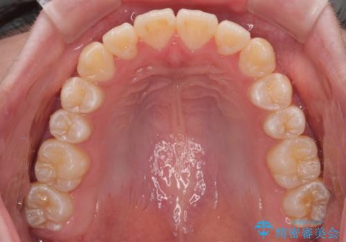 【モニター】前歯のデコボコをスッキリ解消!目立ちにくいワイヤー矯正でスピーディに治療完了の治療後
