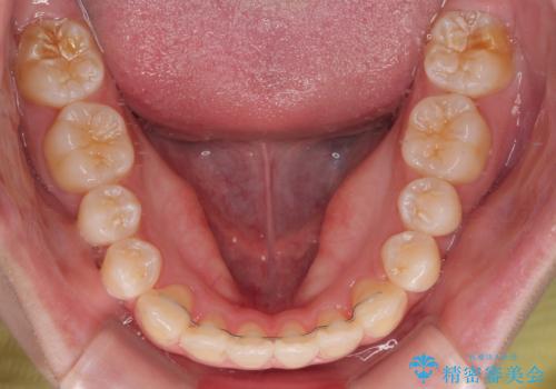 【モニター】前歯のデコボコをスッキリ解消!目立ちにくいワイヤー矯正でスピーディに治療完了の治療後