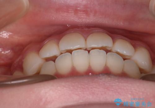 【審美装置】前歯で噛めない!抜歯しないで治したいの治療後