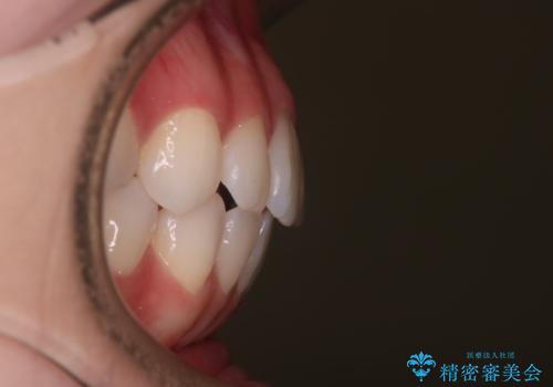 【審美装置】前歯で噛めない!抜歯しないで治したいの治療後