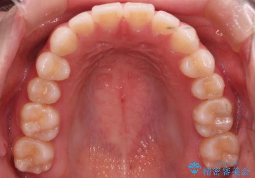 【審美装置】前歯で噛めない!抜歯しないで治したいの治療後