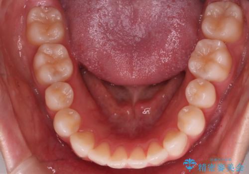 【審美装置】前歯で噛めない!抜歯しないで治したいの治療後