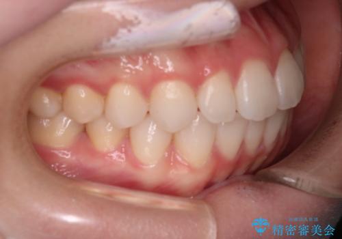 【審美装置】前歯で噛めない!抜歯しないで治したいの治療後