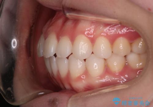 【審美装置】前歯で噛めない!抜歯しないで治したいの治療後