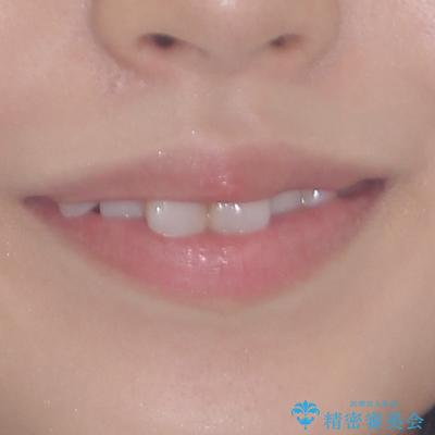 マウスピースが面倒くさい インビザラインでできるところまで頑張った矯正治療の治療前(顔貌)