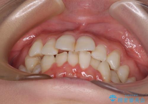 マウスピースが面倒くさい インビザラインでできるところまで頑張った矯正治療の治療前