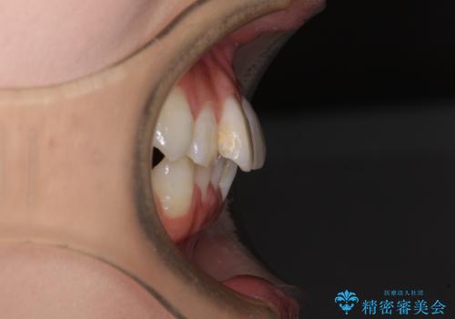 マウスピースが面倒くさい インビザラインでできるところまで頑張った矯正治療の治療前