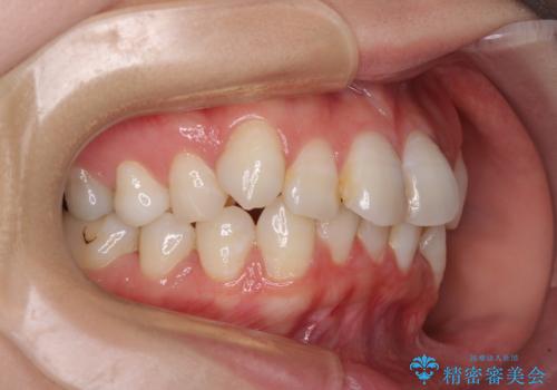 マウスピースが面倒くさい インビザラインでできるところまで頑張った矯正治療の治療前