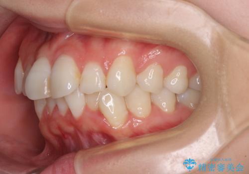 マウスピースが面倒くさい インビザラインでできるところまで頑張った矯正治療の治療前