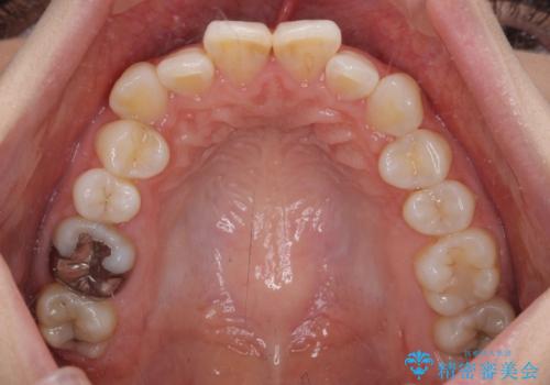 マウスピースが面倒くさい インビザラインでできるところまで頑張った矯正治療の治療前