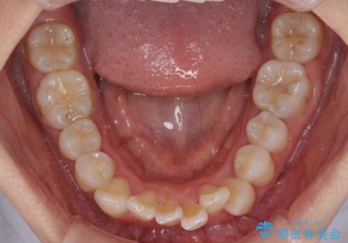 マウスピースが面倒くさい インビザラインでできるところまで頑張った矯正治療の治療前