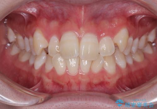 【モニター】前歯のデコボコをスッキリ解消!目立ちにくいワイヤー矯正でスピーディに治療完了の症例 治療前