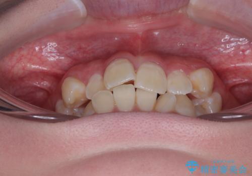 【モニター】前歯のデコボコをスッキリ解消!目立ちにくいワイヤー矯正でスピーディに治療完了の治療前