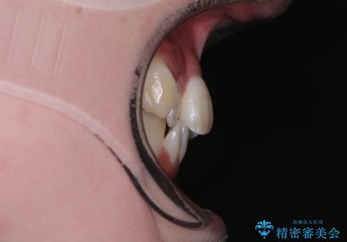 【モニター】前歯のデコボコをスッキリ解消!目立ちにくいワイヤー矯正でスピーディに治療完了の治療前