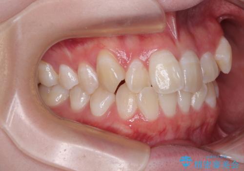 【モニター】前歯のデコボコをスッキリ解消!目立ちにくいワイヤー矯正でスピーディに治療完了の治療前